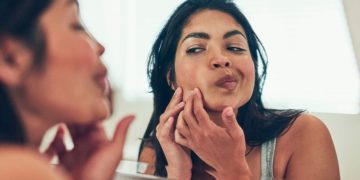 Sivilce neden oluşur ve nasıl geçer?