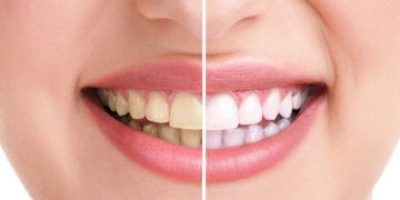 Dişler neden sararır? Diş sararması nasıl gider? Doğal çözüm