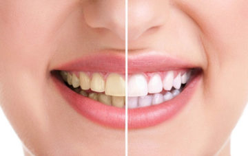 Dişler neden sararır? Diş sararması nasıl gider? Doğal çözüm